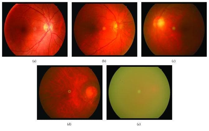 This clinical comparison chart presents five fundus photographs (labeled a–e) demonstrating a progressive grading scale (0–4) for retinal image blurriness, typically caused by lens opacities like cataracts.
- Grade 0 (a): Represents a clear, healthy retina. The optic disc is sharply defined, and both primary retinal vessels and fine capillary networks are clearly visible with high contrast against the fundus.
- Grade 1 (b): Shows mild blurriness where primary vessels remain visible, but distal capillary vessels become faint.
- Grade 2 (c): Moderate blurriness results in the loss of small vessels, leaving only primary vessels faintly detectable.
- Grade 3 (d): Severe blurriness where the optic disc and peripapillary vessels are only indistinctly visible; anatomical details are significantly obscured.
- Grade 4 (e): Total loss of retinal detail; no anatomical structures are discernible due to dense opacity.
This sequence illustrates the clinical challenge of imaging the posterior segment in cataract patients, serving as a reference for diagnostic grading and determining the necessity of surgical intervention based on image quality degradation.