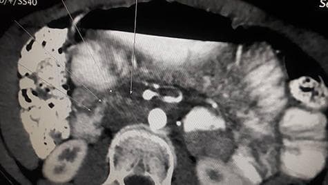 This diagnostic axial contrast-enhanced CT scan of the abdomen demonstrates classic findings of Superior Mesenteric Artery (SMA) Syndrome. The image shows significant proximal duodenal dilation transitioning into an abrupt narrowing (transition zone) as the duodenum passes through the angle between the abdominal aorta (AA) and the superior mesenteric artery (SMA). The third part of the duodenum is visibly compressed in the narrow aortomesenteric space. The scan highlights a reduced aortomesenteric distance and angle, leading to proximal gastrointestinal obstruction. Annotations indicate the key vascular landmarks (SMA and aorta) and the site of duodenal compression. This imaging is clinically significant for diagnosing Wilkie's syndrome in patients presenting with symptoms of high intestinal obstruction. It serves as an educational example of vascular compression of the gastrointestinal tract and the radiological evaluation of the aortomesenteric region.