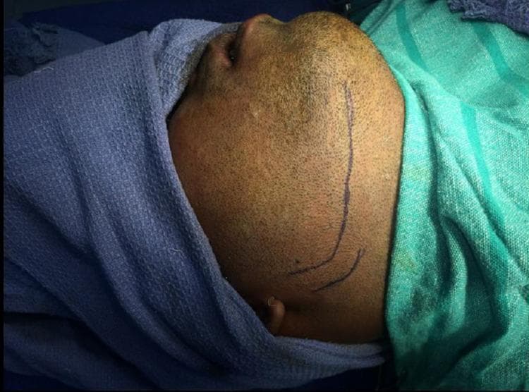 This clinical photograph shows a close-up, lateral view of a male patient's right face and neck in a preoperative surgical setting. The patient is supine with the head turned to the left and draped for a maxillofacial procedure. A clear, blue surgical marking indicates a retromandibular incision line. The marking begins approximately 0.5 cm inferior to the earlobe and extends inferiorly for several centimeters, following a course just posterior to the posterior border of the mandible and curving slightly toward the mandibular angle. A smaller, parallel auxiliary line is marked inferiorly to guide the surgical approach. This visualization demonstrates the planned incision site for a retromandibular transmasseteric approach, commonly used in oral and maxillofacial surgery for the open reduction and internal fixation (ORIF) of mandibular subcondylar fractures. The anatomical landmarks visible include the external ear, the ramus and angle of the mandible, and the cervical region, which serve as essential reference points for avoiding injury to the facial nerve (marginal mandibular branch) and parotid gland during dissection.