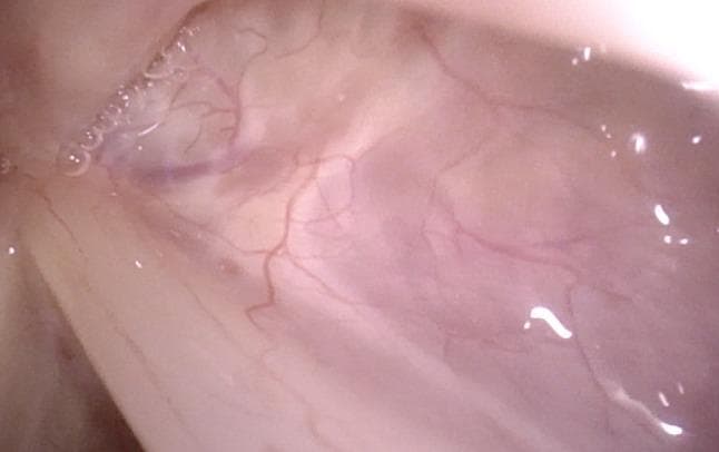 This clinical photograph displays a high-magnification endoscopic view of a normal human larynx, specifically targeting the anterior region of the right sinus Morgagni (laryngeal ventricle). The image, captured via a specialized rotation maneuver during flexible laryngoscopy, shows the healthy mucosal lining of the ventricle. The tissue is characterized by a healthy pinkish hue with a smooth, moist texture. Fine, branching subepithelial blood vessels are clearly visible, illustrating the normal vascular pattern of the laryngeal mucosa. Small fluid droplets and light reflections on the surface indicate the physiological presence of mucus. This perspective is educationally significant for demonstrating the ability to visualize deep laryngeal recesses, such as the ventricle and the inferior aspect of the vocal folds, which are often obscured during standard distal laryngoscopy.