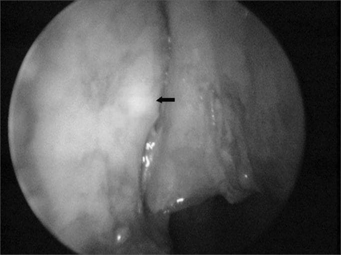 This endoscopic clinical photograph displays the internal anatomy of the lateral nasal cavity during a dacryocystorhinostomy (DCR) procedure. The image focuses on the bony lateral nasal wall, where the overlying mucosa has been surgically reflected or removed to expose the underlying bone. A black arrow indicates a distinct 'transillumination point,' a localized area of increased brightness. This point represents light from an optical fiber probe inserted through the lacrimal canaliculus, used to precisely locate the lacrimal sac through the lacrimal bone. The surrounding structures include the vertical orientation of the bony wall and adjacent mucosal folds. This diagnostic and surgical imaging technique is essential for ophthalmological and ENT surgeons to identify the correct site for creating an osteotomy, ensuring direct access to the lacrimal sac for bypass of a nasolacrimal duct obstruction. The visual provides a clear example of intraoperative navigation and anatomical localization within the nasal meatus.