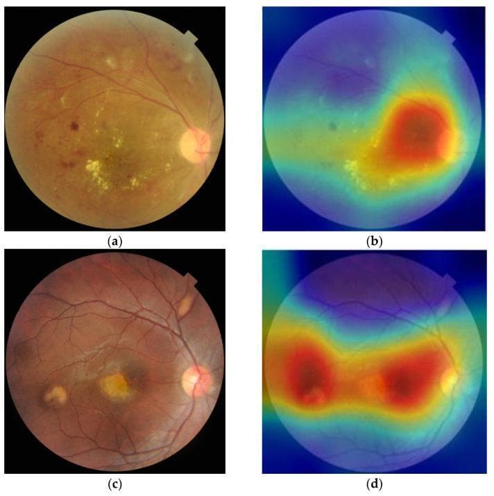 This medical figure presents a side-by-side comparison of diagnostic fundus images (a, c) and their corresponding AI-generated heatmaps (b, d) using Guided-Grad-CAM (Gradient-weighted Class Activation Mapping).
Image (a) displays a fundus photograph characteristic of diabetic retinopathy (DR), showing scattered yellowish-white hard exudates and punctate microaneurysms against a yellowish-brown retinal background. Image (c) illustrates complex retinal pathology, including central retinal vein occlusion (CRVO) features and retinal pigment epithelium (RPE) changes, characterized by larger, distinct pale lesions and irregular macular pigmentation.
The corresponding heatmaps (b, d) utilize a color-coded spectrum to indicate model attention areas for multi-label classification. Red and yellow 'hot' zones represent regions of highest influence on the diagnostic algorithm, specifically localizing to the visible pathological exudates and RPE alterations. These visualizations demonstrate the clinical utility of deep learning models in identifying and localizing retinopathy-related features within ophthalmology, aiding in the automated detection of sight-threatening diseases.
