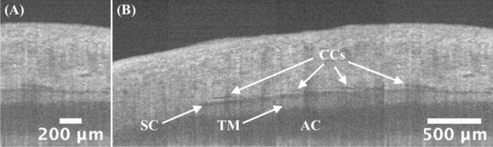 This diagnostic image displays high-resolution, circumferential spectral-domain optical coherence tomography (SD-OCT) of the human iridocorneal angle. Panel (A) provides a detailed cross-sectional view of the limbus region with a 200 µm scale bar. Panel (B) presents a larger 'panoramic' concatenated view (3.5 mm coverage) with a 500 µm scale bar, illustrating the aqueous outflow pathway. Key anatomical structures labeled include the Trabecular Meshwork (TM), visible as a band of intermediate reflectivity; Schlemm's Canal (SC), appearing as a low-intensity, horizontally oriented lumen; and multiple Collector Channels (CCs) branching from the SC. The Anterior Chamber (AC) is visualized at the bottom of the scans. These circumferential images demonstrate morphological variations and pattern changes in the outflow system, which is clinically significant for preoperative planning in glaucoma microinvasive surgeries. The imaging highlights the continuity and branching patterns of the ocular drainage structures necessary for understanding aqueous humor dynamics.