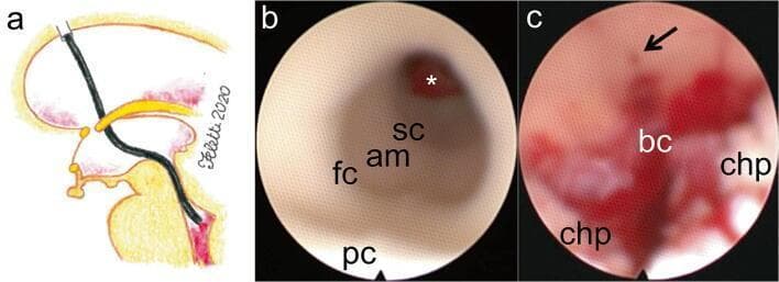This composite educational resource illustrates the endoscopic management of intraventricular hemorrhage (IVH) via transaqueductal navigation. (a) A sagittal anatomical diagram depicts the trajectory of a flexible neuroendoscope from a precoronal burr hole through the lateral and third ventricles into the fourth ventricle. (b) An intraoperative endoscopic image shows the internal anatomy of the cerebral aqueduct, identifying the floor (fc), ampulla (am), and second constriction (sc). A prominent blood clot (*) is visible obstructing the distal egressus of the aqueduct near the posterior commissure (pc). (c) A subsequent intraoperative view demonstrates the inferior triangle of the fourth ventricle post-aspiration. Key landmarks include the choroid plexus (chp) on the ventricular roof and the canalis centralis medullaris at the calamus scriptorius (arrow). Residual blood clots (bc) are noted obstructing the foramen of Magendie. This visual sequence highlights the surgical approach to restoring cerebrospinal fluid (CSF) pathway patency in cases of obstructive hydrocephalus caused by hemorrhage.
