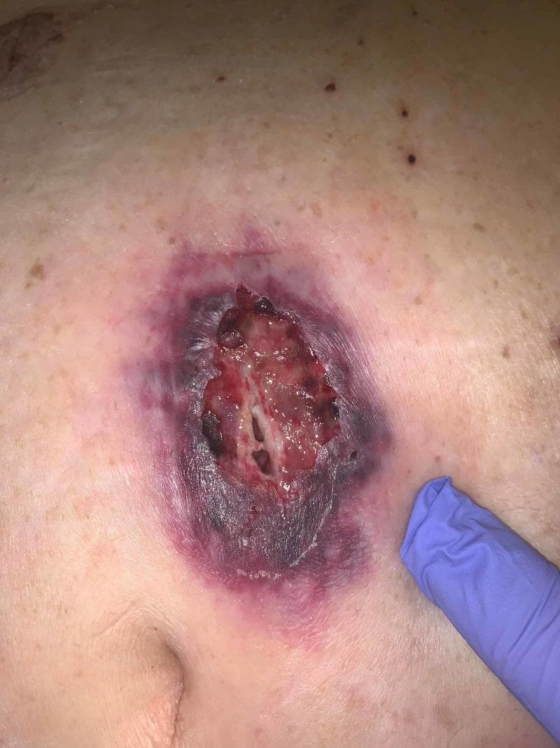 This clinical photograph displays a large, ulcerative skin lesion on the abdomen of a 66-year-old patient, characteristic of pyoderma gangrenosum (PG) manifesting at a post-operative port site. The central ulceration shows a deep, beefy red base with areas of necrotic tissue, yellow slough, and visible undermining or tunneling. The most distinctive feature is the well-demarcated, gunmetal grey to violaceous, undermined border that is surrounded by a halo of erythematous, inflamed skin. The lesion is located near the umbilicus, with a faint horizontal surgical scar visible superiorly. This image serves as a classic educational example of pathergy, where a skin condition is triggered or worsened by surgical trauma. The clinical context involves a patient with underlying inflammatory arthritis and myelodysplastic syndrome, highlighting the systemic associations often found with PG. The visual presentation is critical for distinguishing PG from infectious processes, emphasizing the characteristic 'violaceous border' and 'undermining' required for clinical diagnosis and subsequent management with immunosuppressive therapy rather than surgical debridement.