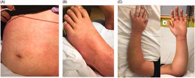 This composite clinical photograph displays the dermatological and musculoskeletal presentation of a pediatric patient with systemic illness, likely Toxic Shock Syndrome secondary to Group A Streptococcus infection. Panel A shows the abdomen/trunk with a diffuse, erythematous macular rash consisting of non-elevated, blanching red spots. Panel B illustrates similar macular findings on the dorsal surface of the foot and lower leg. Panel C provides two views (dorsal and volar) of the left upper extremity, demonstrating significant localized edema (swelling) of the forearm, wrist, and hand. The skin of the forearm appears erythematous and tense, though no overt skin breaks or cellulitis are visible at the time of presentation. This combination of findings—a diffuse scarlatiniform-like rash and localized extremity swelling—is clinically significant for identifying early signs of invasive soft tissue infection and systemic inflammatory response.