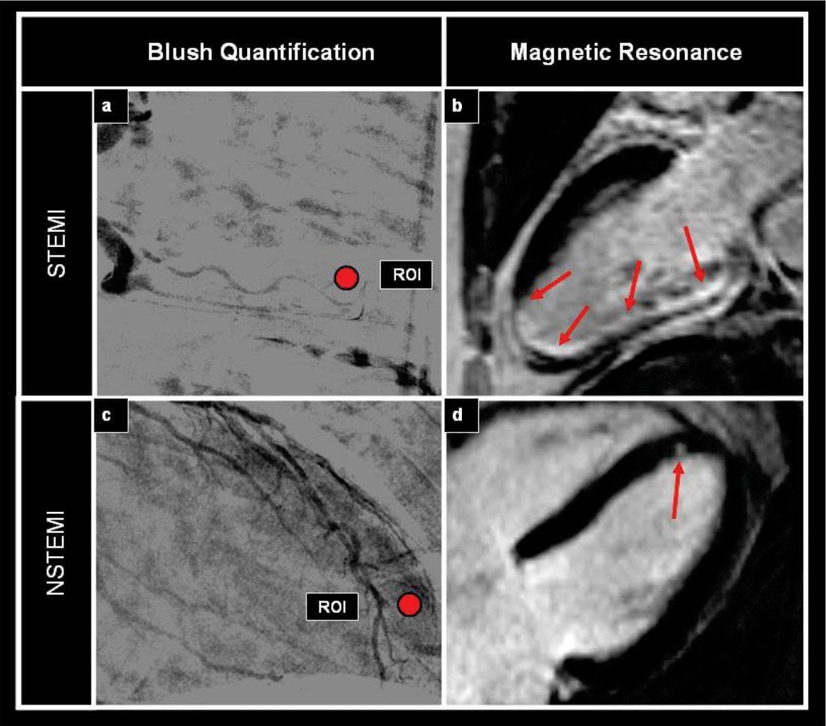A comparative diagnostic image panel illustrating differences between ST-elevation myocardial infarction (STEMI) and non-ST-elevation myocardial infarction (NSTEMI) using angiographic blush quantification and cardiac magnetic resonance (CMR). The top row (a, b) displays STEMI findings: (a) an angiographic frame with a circular red Region of Interest (ROI) showing reduced myocardial blush, and (b) a delayed-enhancement CMR image showing extensive hyperenhancement (red arrows) indicating a large transmural inferior wall infarct. The bottom row (c, d) displays NSTEMI findings: (c) an angiographic frame with higher myocardial blush density within the ROI, and (d) a delayed-enhancement CMR image showing a small, localized area of subendocardial hyperenhancement (red arrow) in the anterior wall. The visual comparison highlights the greater infarct size and transmurality associated with STEMI compared to the smaller, non-transmural nature of NSTEMI, as well as the corresponding differences in microvascular perfusion (blush) between the two clinical presentations.