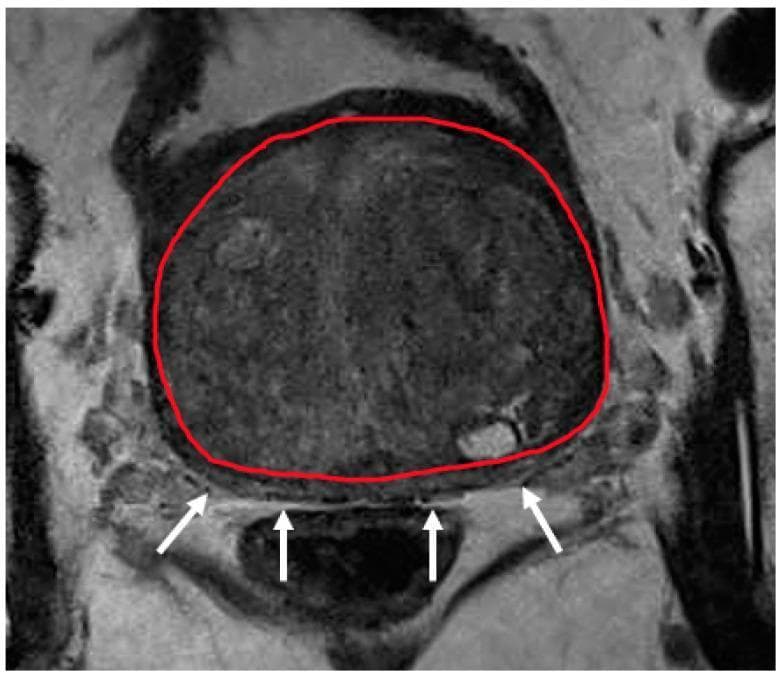 This diagnostic axial MRI scan (T2-weighted) of the prostate illustrates severe benign prostatic hyperplasia (BPH) with transition zone hypertrophy. The transition zone is segmented with a red outline, occupying the vast majority of the prostatic volume and exhibiting a heterogeneous, predominantly medium-gray signal intensity. Due to this significant expansion, the peripheral zone is severely compressed and displaced posteriorly, visible only as a thin, crescent-shaped sliver of lower signal intensity, indicated by white arrows. This image demonstrates a common challenge in prostatic zonal segmentation and radiological assessment: the effacement of anatomical landmarks between the transition and peripheral zones. The anatomical region focuses on the mid-gland level of the prostate. Educational focus includes understanding prostatic zonal anatomy, the pathophysiological effect of transition zone expansion on surrounding tissues, and the clinical imaging characteristics of severe hypertrophy in the context of urological diagnostics and radiotherapy planning.