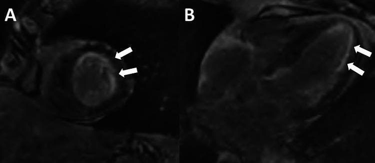 Two-panel cardiac magnetic resonance imaging (MRI) demonstrating late gadolinium enhancement (LGE) patterns characteristic of cardiac amyloidosis. Image A presents a short-axis view of the left ventricle, where white arrows highlight a diffuse, hyperintense white stripe along the subendocardial layer of the anterolateral wall. Image B shows a four-chamber view, further illustrating this diffuse subendocardial LGE pattern within the ventricular walls. The enhancement represents abnormal gadolinium kinetics and extracellular space expansion typical of infiltrative cardiomyopathies. Key educational findings include the non-ischemic, subendocardial distribution of the enhancement and its diffuse nature, which are critical diagnostic markers for identifying systemic AL amyloidosis with cardiac involvement in clinical cardiology and radiology.