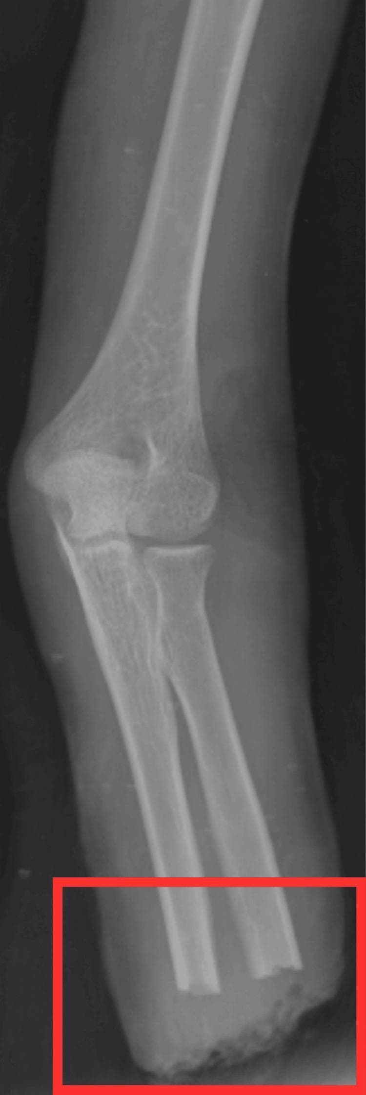 This diagnostic X-ray (radiograph) illustrates a post-operative status of a transradial amputation in an upper limb. The image captures the distal humerus, elbow joint, and the proximal portions of the radius and ulna. The elbow joint maintains its anatomical alignment. Distally, the radius and ulna are sharply and transversely truncated, demonstrating a clear surgical bone cut consistent with amputation at the mid-to-distal forearm level. A red rectangle highlights this amputation site. The bone density appears normal with visible trabecular patterns in the proximal segments. Surrounding soft tissues are visible as less radiopaque shadows, terminating abruptly at the surgical margin. There is a slight mottled appearance of the soft tissue at the distal end, likely representing post-operative edema, surgical dressing material, or inflammatory changes. This visual serves as a clinical example of post-surgical imaging for limb amputation monitoring and orthopedic evaluation.