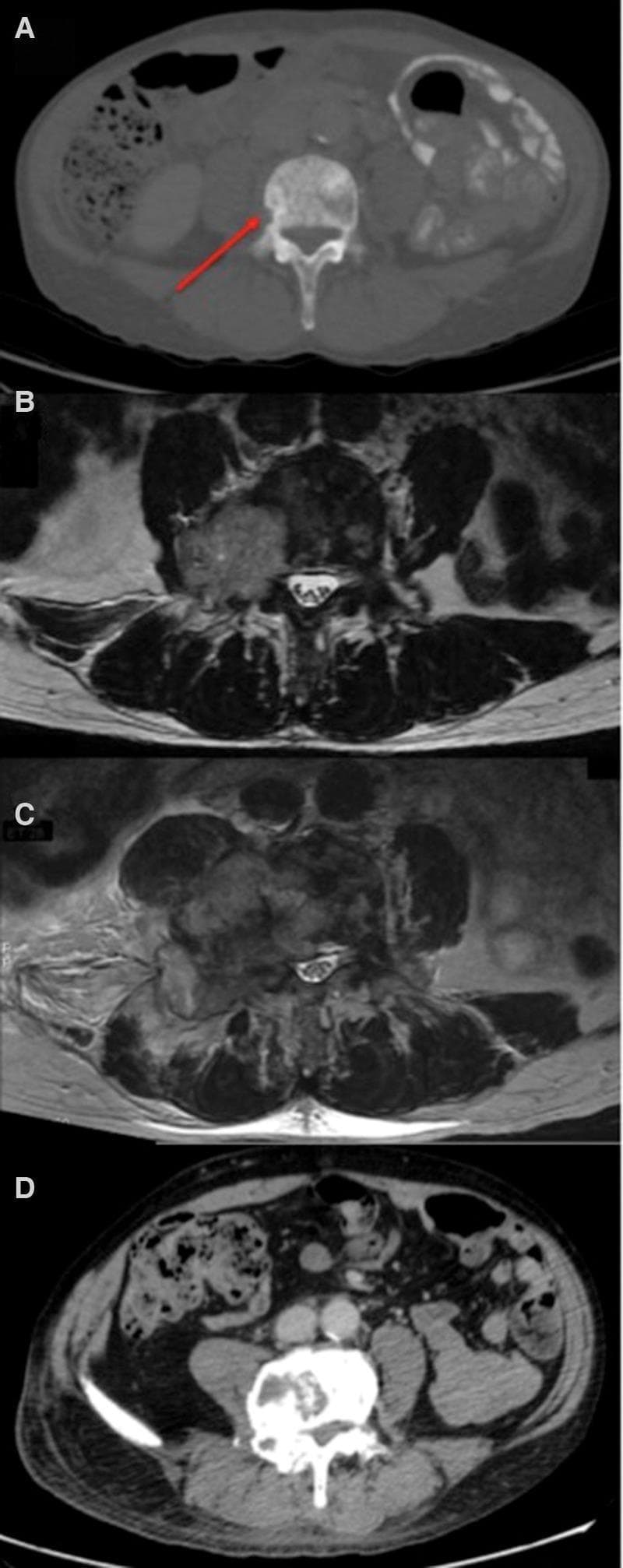This composite of four radiological images illustrates the clinical progression and treatment response of metastatic prostate cancer in the lumbar spine. (A) Axial CT scan in a soft tissue window showing initial staging; a red arrow highlights mild cortical erosion of the vertebral body, indicating early bone metastasis. (B) Axial T2-weighted MRI at 2.5 months demonstrates an aggressive lesion in the L4 vertebra invading the right pedicle and encroaching upon the spinal canal. (C) Axial MRI at 4 months reveals significant disease progression, with the L4 lesion increasing in size and exhibiting extensive metastatic marrow infiltration and soft tissue extension. (D) Axial CT scan in a bone window at 10.5 months demonstrates a marked radiological response following a change in chemotherapy regimen, showing significant reduction of the tumor mass and partial remodeling of the L4 vertebral structure. The series serves as an educational example of monitoring metastatic disease using multimodal imaging (CT and MRI) and correlating radiological findings with clinical transitions between adenocarcinoma and small-cell carcinoma phenotypes.