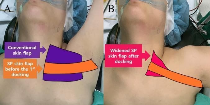 This clinical photograph set (Figures 4A and 4B) illustrates a comparison of skin flap dissection areas for robotic transaxillary thyroidectomy. The images show a patient in a supine position with surgical markings. In Figure 4A, a 'conventional skin flap' (purple) is depicted as a large, trapezoidal area extending from the axilla across the upper chest toward the sternal notch and lower neck. Overlaid on this is the 'SP (Single Port) skin flap before the 1st docking' (orange), which is significantly narrower and confined to a direct path from the axilla to the midline. Figure 4B demonstrates the 'widened SP skin flap after docking' (pink), showing a triangular expansion toward the superior neck and thyroid region compared to the initial orange tract. The series highlights the technical advancement of the da Vinci SP system, which allows for a more targeted, minimally invasive dissection compared to traditional robotic thyroidectomy approaches. The anatomical focus is the pectoralis major surface, sternocleidomastoid muscle, and the surgical access pathway from the axilla to the thyroid gland.