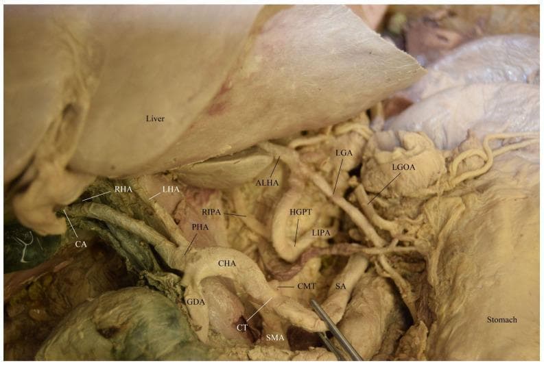 This clinical photograph displays a detailed cadaveric dissection of the upper abdominal vasculature, focusing on rare anatomical variations of the celiac region. The primary feature is a celiacomesenteric trunk (CMT), where the celiac trunk (CT) and superior mesenteric artery (SMA) share a common origin. The CT further bifurcates into the splenic artery (SA) and the common hepatic artery (CHA). Adjacent to this, a distinct hepatogastrophrenic trunk (HGPT) is visible, giving rise to the left gastric artery (LGA), left inferior phrenic artery (LIPA), and an accessory left hepatic artery (ALHA). Further branching of the hepatic system shows the CHA dividing into the gastroduodenal artery (GDA) and proper hepatic artery (PHA), with the latter branching into the right hepatic artery (RHA), left hepatic artery (LHA), and right inferior phrenic artery (RIPA). The cystic artery (CA) is seen near the hepatic hilum. Key landmarks include the liver (superiorly retracted) and the stomach. This image serves as an advanced educational resource for surgical anatomy, illustrating complex vascular anomalies critical for hepatobiliary and gastric surgical planning.