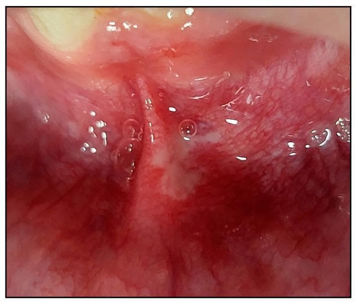 A close-up clinical photograph of the oral cavity showcasing a Major Recurrent Aphthous Stomatitis (MaRAS) lesion. The lesion is located on the non-keratinized labial mucosa, specifically involving the labial sulcus and extending across the lateral border of the lower midline frenum. Visually, the ulcer presents as a well-defined area covered by a white-to-yellowish pseudomembranous slough. This central ulceration is encircled by a prominent, diffuse erythematous halo, indicating acute inflammatory response. The surrounding mucosal tissue appears moist and highly vascularized. This image serves as a clinical example of the morphology and anatomical distribution typical of major aphthous ulcers, emphasizing their size and involvement of mucosal folds compared to minor variants.