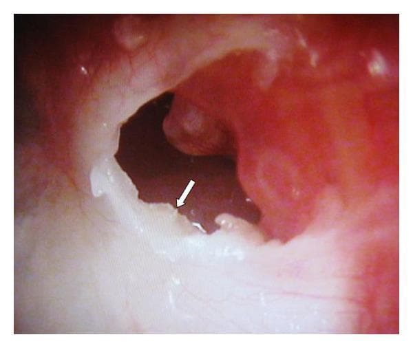 This clinical photograph shows an otoendoscopic view of a left tympanic membrane (TM) exhibiting a marginal perforation in the posterosuperior quadrant. The TM appears thickened, opaque, and creamy-white in color, suggesting chronic inflammatory changes or myringosclerosis. A prominent feature is the presence of white, flaky keratin debris (indicated by a white arrow) emerging from the medial surface of the TM through the perforation. The surrounding ear canal and margins of the perforation appear erythematous and inflamed. The image illustrates findings characteristic of chronic otitis media, potentially involving a cholesteatoma or keratoma, as evidenced by the accumulation of keratin in the middle ear space. This visual is relevant for otolaryngology education, specifically for identifying structural ear defects, distinguishing between central and marginal perforations, and recognizing clinical signs of keratin pearl or cholesteatoma formation.
