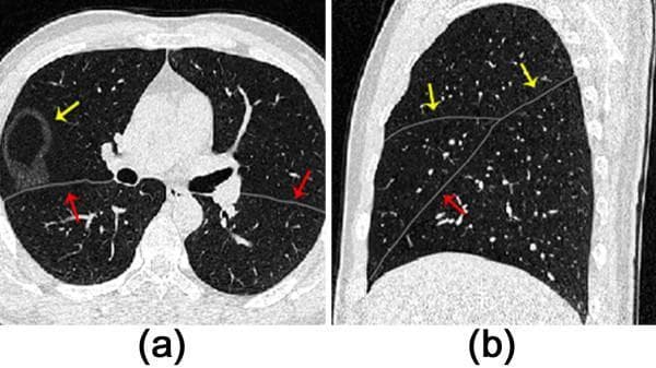This diagnostic image displays two computed tomography (CT) sections of the thorax in lung window settings, focusing on the identification and segmentation of pulmonary fissures. Image (a) is an axial view showing both lungs. A thin, low-density line (marked by red arrows) represents the major fissure, while a circular, thick-walled cavitary lesion is visible in the right lung (indicated by a yellow arrow). Small, punctate high-attenuation structures represent pulmonary vasculature within the air-filled (low-attenuation) lung parenchyma. Image (b) provides a sagittal view of the right lung, highlighting the anatomical orientation of the pulmonary fissures. Two distinct thin gray lines intersect, representing the major (oblique) and minor (horizontal) fissures (yellow and red arrows). The sagittal plane demonstrates how these fissures partition the lung into superior, middle, and inferior lobes. This visual is primarily used in radiology education to teach fissure anatomy and computer-aided detection (CAD) algorithms for automated lobe segmentation.