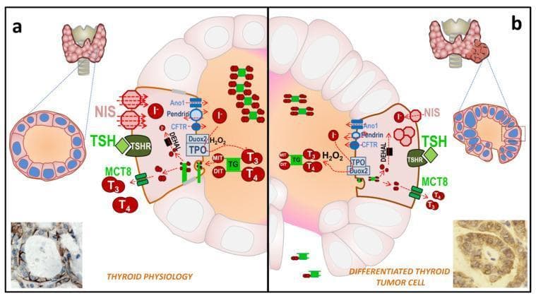 This comparative medical illustration depicts thyroid hormone (TH) biosynthesis in a normal follicle (Panel A) versus a differentiated thyroid cancer (DTC) cell (Panel B). Panel A illustrates normal physiology: a well-organized follicular structure with follicular epithelial cells surrounding a central colloid. Key proteins shown include the sodium/iodide symporter (NIS) localized strictly at the basolateral membrane, the TSH receptor (TSHR), and apical transporters like pendrin and Ano1. Iodide (I-) organification via thyroperoxidase (TPO) and Duox2-generated H2O2 is shown creating iodinated thyroglobulin (TG-I), leading to T3 and T4 synthesis. Panel B represents the pathophysiology of DTC, highlighting structural irregularities in the follicle and cellular alterations. Pathological changes include the delocalization of NIS from the basolateral membrane into the cytoplasm and a reduction in the expression of functional proteins like pendrin and TSHR. While H2O2 production persists, the synthesis and storage of TG-I and TH (T3/T4) in the colloid are visibly diminished. Bottom insets provide immunohistochemistry (IHC) correlations, confirming linear basolateral NIS expression in normal tissue versus diffuse, cytoplasmic NIS staining in tumor tissue.