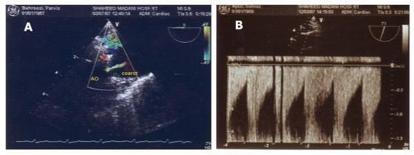 This dual-panel diagnostic image displays Transesophageal Echocardiography (TEE) and Doppler ultrasound findings of aortic coarctation. Panel A presents a color Doppler TEE of the thoracic aorta (AO). It highlights a focal narrowing labeled 'coarct', where turbulent, high-velocity blood flow is visualized as a multicolored mosaic pattern (aliasing), indicating significant stenosis distal to the left subclavian artery. Panel B shows a pulse-wave Doppler spectral waveform obtained at a site distal to the coarctation. The waveform exhibits a characteristic 'parvus-tardus' pattern, defined by a delayed systolic upstroke (tardus), a rounded or blunted systolic peak, and a low overall amplitude (parvus). This dampened flow profile is a hallmark hemodynamic finding of hemodynamically significant proximal arterial obstruction. Together, these images demonstrate the anatomical and functional evaluation of secondary hypertension caused by congenital aortic narrowing in an adult patient.