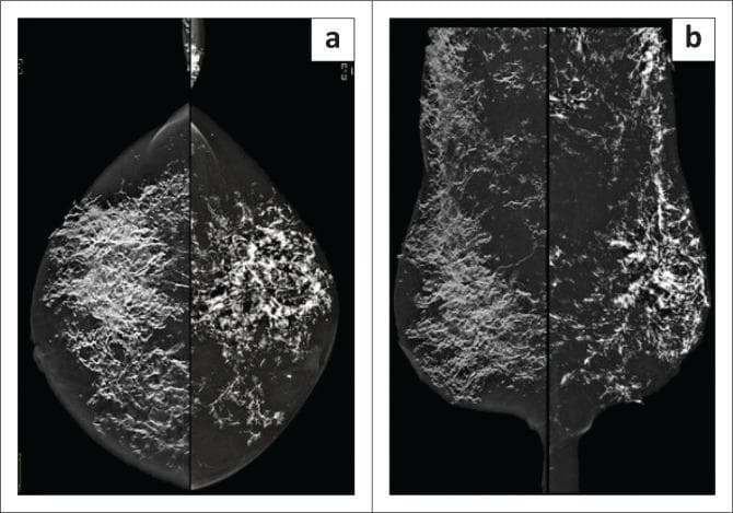 This diagnostic image consists of bilateral mammogram views, including Craniocaudal (CC, image a) and Mediolateral Oblique (MLO, image b) projections. The mammograms reveal extensive, high-density calcifications distributed throughout the parenchyma and subcutis of both breasts. These calcifications exhibit a distinct coarse, linear, and bizarre morphology characteristic of dystrophic calcification. The distribution is widespread and diffuse, significantly obscuring the normal glandular stroma. Notably, the pectoralis muscles seen on the MLO views are relatively spared, indicating the process is primarily confined to the breast tissue and superficial layers. This presentation is clinically significant for systemic conditions such as calcinosis cutis or calcification secondary to connective tissue disorders, such as ANCA-negative panniculitis, rather than typical breast malignancy.