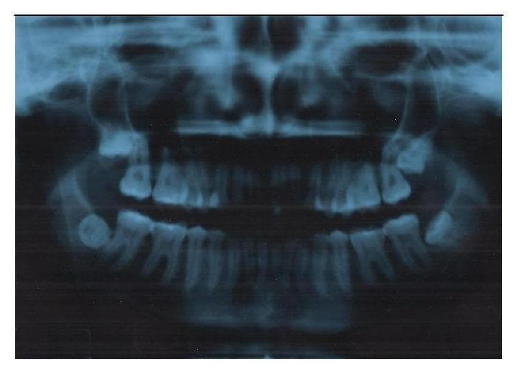 This diagnostic image is an orthopantomogram (panoramic X-ray) of the human maxilla and mandible, illustrating several dental anomalies and surgical landmarks. The primary educational focus is on the impaction of all four third molars (teeth 18, 28, 38, and 48). In the upper right quadrant, the third molar (18) exhibits vertical impaction in close proximity to the floor of the maxillary sinus. In the upper left, the third molar (28) shows mesioangular impaction. Both mandibular third molars (38 and 48) demonstrate horizontal impaction, with tooth 38 showing a Pell and Gregory Class 2 depth and tooth 48 displaying significant vestibularization. The radiograph also allows for the assessment of root morphology across the dental arches and the spatial relationship between the mandibular molars and the inferior alveolar nerve canal. This imaging is characteristic of preoperative assessment in oral and maxillofacial surgery for planning complex extractions.