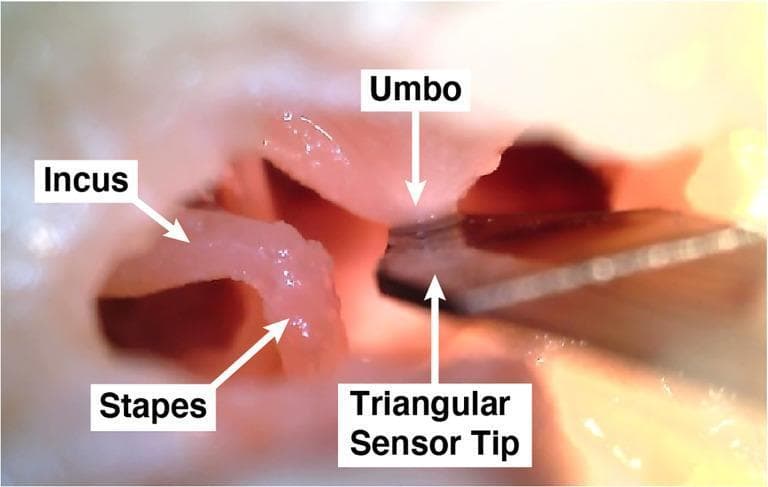 This clinical photograph shows a close-up, internal view of the human middle ear cavity from a cadaveric specimen, illustrating the anatomical components of the ossicular chain and an experimental medical device. Visible anatomical structures include the incus, the stapes, and the umbo—the conical point on the internal surface of the tympanic membrane where the manubrium of the malleus attaches. The soft tissues and ossicles appear pinkish-white with a moist texture. A dark, metallic, triangular sensor tip (part of the 'UmboMic' piezoelectric apparatus) is positioned in direct contact with the umbo. This setup is used to detect the mechanical vibrations and displacement of the tympanic membrane for research into middle ear microphone technology. The image highlights the spatial relationship between the ossicles and the positioning requirements for intra-tympanic sensing devices. The educational focus is on otologic anatomy and the integration of implantable hearing technology within the middle ear space.