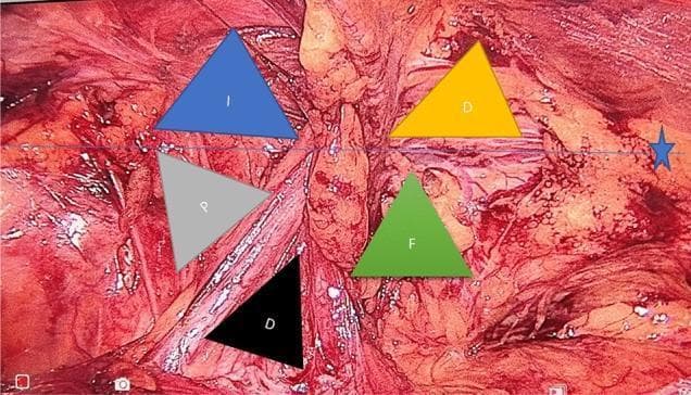 This endoscopic clinical photograph illustrates the surgical anatomy of the posterior abdominal wall during a laparoscopic inguinal hernia repair (TAPP). The image depicts five critical anatomical zones, superimposed as color-coded triangles, essential for avoiding neurovascular complications. A blue star and line denote the inguinal ligament. The triangles are labeled as follows: Blue 'I' for the Indirect hernia space; Yellow 'D' for the Direct hernia space; Grey 'P' for the 'Triangle of Pain' (bounded by the spermatic vessels and iliopubic tract, containing the femoral branch of the genitofemoral nerve and lateral femoral cutaneous nerve); Black 'D' for the 'Triangle of Doom' (bounded by the vas deferens and spermatic vessels, containing the external iliac vessels); and Green 'F' for the Femoral hernia space. This visualization serves as a surgical guide to the 'myopectineal orifice' anatomy, emphasizing safe zones for mesh fixation and areas to avoid tacking to prevent chronic pain or hemorrhage.
