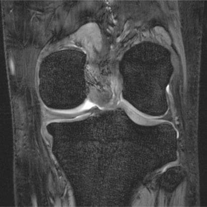 This diagnostic image is an ultra-high resolution, coronal plane 7 Tesla (7T) gradient-echo Magnetic Resonance Image (MRI) of the human knee joint. The imaging demonstrates exceptional detail of the musculoskeletal anatomy, specifically targeting the tibiofemoral joint. Key visible structures include the medial and lateral femoral condyles and the tibial plateau, both showing a dark signal intensity with a highly defined, interconnected network of bright and dark lines representing the fine trabecular bone architecture. The hyaline cartilage layers covering the articular surfaces appear as bright, smooth, and continuous hyperintense bands, allowing for precise assessment of thickness and surface integrity. The medial and lateral menisci are clearly visualized as dark, low-signal, wedge-shaped structures situated within the joint space. This ultra-high-field modality provides the spatial resolution necessary to detect subtle chondral defects, meniscal micro-tears, and changes in subchondral bone density, making it a valuable tool in both advanced clinical diagnostics and osteoporosis research.