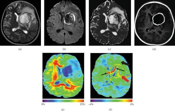 This composite of six brain MRI images demonstrates a pyogenic brain abscess in the left basal ganglia. (a) Axial T2-weighted image shows a well-defined hyperintense round lesion with significant surrounding vasogenic edema. (b) DWI and (c) ADC map illustrate restricted diffusion within the abscess cavity, characteristic of purulent material. (d) Post-contrast T1-weighted image reveals classic smooth, thin rim enhancement surrounding a non-enhancing necrotic center. (e) Magnetization Transfer Ratio (MTR) map shows low signal intensity within the enhancing rim and edematous areas. (f) Amide Proton Transfer-weighted (APTw) imaging displays a distinctive high signal (red arrow) at the gadolinium-enhancing rim, contrasting with the lower signal in the perifocal edema (black arrow). The internal liquefactive necrosis and ventricles exhibit an alternating hyper- and hypointense APTw pattern (thin black arrows). This series illustrates how advanced molecular MRI techniques like APTw can complement conventional imaging in characterizing the inflammatory environment and protein content of infectious intracranial lesions.