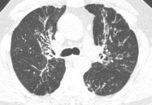 This diagnostic image is an axial computed tomography (CT) scan of the chest at the level of the upper lobes, highlighting classic manifestations of Allergic Bronchopulmonary Aspergillosis (ABPA). The primary finding is multifocal central bronchiectasis, characterized by irreversible dilation of the proximal bronchi with a distinct upper lobe predominance. Associated secondary findings include focal areas of atelectasis and localized ground-glass opacities, which represent hazy increases in lung density. Furthermore, the scan reveals numerous centrilobular nodules—small, discrete densities located within the secondary pulmonary lobules—and evidence of mosaic attenuation. These features collectively illustrate the chronic inflammatory and hypersensitivity response within the airways typical of ABPA. Clinically, this imaging modality is essential for distinguishing central bronchiectasis from more peripheral or basilar-predominant patterns seen in other interstitial lung diseases or infections, providing a key educational example of airway-centered pathology in the context of chronic asthma or cystic fibrosis.