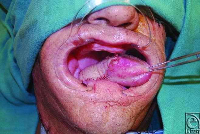 This intraoperative clinical photograph demonstrates a partial glossectomy reconstruction utilizing a free Anterolateral Thigh (ALT) flap. The oral cavity is held open by a transparent plastic retractor, revealing the surgical site. The reconstructed tongue consists of native residual lingual tissue (appearing pink and smooth) and the ALT skin paddle, which is paler with a slightly textured surface. Prominent surgical sutures are visible along the interface where the flap has been inset into the tongue and cheek. Forceps are seen retracting the reconstructed organ to showcase the volume and positioning of the graft. This image illustrates post-oncological head and neck reconstruction, emphasizing the integration of microvascular free tissue transfer to restore oral cavity volume and function. Surgical markings and fresh incisions are also visible on the lower lip and chin areas, typical of a complex oral maxillofacial procedure.