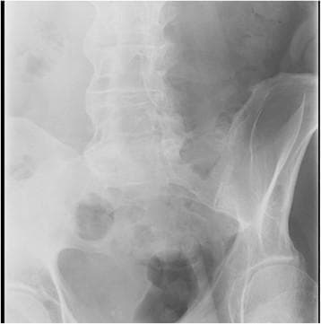 This diagnostic X-ray (radiograph) depicts the lumbar spine and pelvis, highlighting characteristic findings of late-stage Ankylosing Spondylitis (AS). The lumbar vertebrae exhibit extensive ossification of the outer fibers of the annulus fibrosus, forming marginal syndesmophytes. These bony bridges connect adjacent vertebral bodies, resulting in the classic 'bamboo spine' appearance. Furthermore, there is visible fusion of the posterior spinous processes and facet joints. In the pelvic region, the bilateral sacroiliac (SI) joints demonstrate significant pathology, ranging from cortical blurring and erosions to partial ankylosis (fusion), where the joint spaces are narrowed or obliterated by bone bridging. These radiographic features are hallmark indicators of axial spondyloarthritis, reflecting chronic inflammation leading to spinal immobility and structural remodeling. The image serves as a clinical reference for identifying advanced syndesmophytes and sacroiliitis.