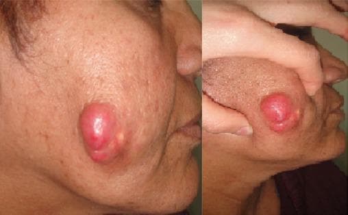 This clinical photograph consists of two views (profile and close-up) showing a prominent skin lesion on the left cheek of an adult patient. The lesion is a well-circumscribed, exophytic, polylobed nodular tumor with a distinctly erythematous or reddish-pink hue. The surface appears smooth, glistening, and tense, suggesting significant underlying pressure or fullness. There is visible evidence of subcutaneous infiltration, as the surrounding skin appears distorted and stretched. Adjacent to the primary mass, smaller pale-yellowish papular elevations are noted, which may represent secondary skin changes or satellite lesions. The medical specialty involved is dermatology or oncology, and the image illustrates the morphology of a firm, rapidly growing or infiltrative cutaneous tumor, requiring differential diagnosis between malignant processes (such as squamous cell carcinoma or Merkel cell carcinoma) and benign but aggressive entities. The educational focus is on identifying visual markers of cutaneous malignancy and the clinical presentation of infiltrative facial tumors.