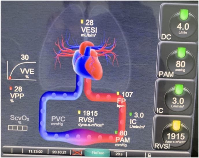 This clinical photograph displays a digital interface of an HemoSphere advanced hemodynamic monitoring system, used in intensive care settings for real-time cardiovascular assessment. The central feature is a stylized anatomical diagram of the heart and circulatory system, where color-coded vessels (blue for venous/deoxygenated and red for arterial/oxygenated) indicate blood flow patterns and pressure points. Key hemodynamic parameters are overlaid on the diagram and listed in a sidebar, including Cardiac Output (DC: 4.0 L/min), Mean Arterial Pressure (PAM: 80 mmHg), Cardiac Index (IC: 3.0 L/min/m²), and Systemic Vascular Resistance Index (RVSI: 1915 dyne-s-m²/cm³). Additional markers show Stroke Volume Variation (VPP: 28%) and Heart Rate (FP: 107 bpm). The display utilizes color-coded status indicators (green for within target range, yellow for borderline) to assist clinicians in the management of patients with cardiac dysfunction or shock, such as post-vaccination myocarditis. This visual tool integrates invasive pulse wave analysis data into an intuitive physiological map for rapid clinical decision-making.