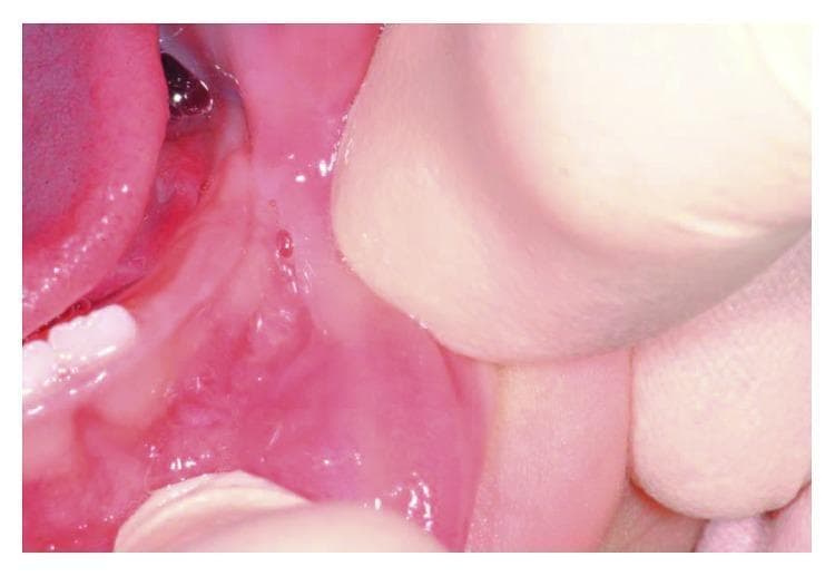 This clinical intraoral photograph shows the lower lip and labial mucosa of a pediatric patient (aged 10 months) during a follow-up examination. The image demonstrates a completely healed surgical site following the laser excision of a mucocele. The mucosa exhibits a healthy, uniform pink color and smooth texture, indicating successful epithelialization without scarring. There are no signs of inflammation, erythema, edema, or mass recurrence in the primary surgical area. The surrounding oral structures, including the deciduous teeth and gingival tissue, appear developmentally normal. The photo illustrates the typical long-term outcome of diode laser surgery for minor salivary gland lesions in infants, highlighting functional and aesthetic recovery of the oral mucosa.