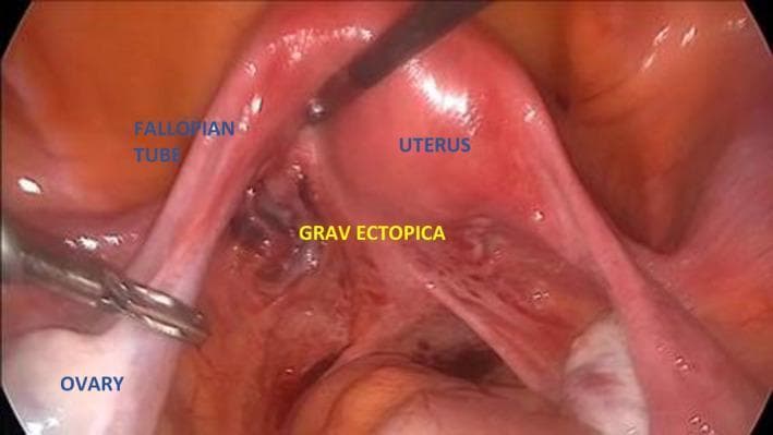 This laparoscopic clinical photograph depicts an intra-abdominal view of the female pelvic anatomy during a diagnostic procedure. The central feature is the uterus, which appears as a pinkish, smooth, and glistening organ. Extending laterally is the fallopian tube, which maintains a thin, tubular morphology. An ectopic pregnancy, labeled 'GRAV ECTOPICA', is visible as a dark, reddish-brown, irregular heteroechoic mass located at the base of the posterior lamina of the broad ligament, adjacent to the uterus. The ovary is situated distally and is being manipulated by a laparoscopic grasper. The image illustrates a rare site for ectopic implantation while highlighting the contrast between the healthy, vascularized uterine tissue and the darker, congested appearance of the ectopic gestation. This visual is significant for teaching the laparoscopic identification of adnexal masses and the surgical anatomy of the broad ligament in the context of early pregnancy complications.