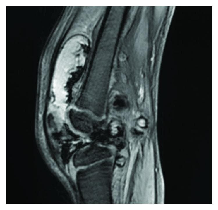 This diagnostic image is a sagittal T2-weighted magnetic resonance imaging (MRI) scan of a human knee joint. The most prominent finding is a massive, complex joint effusion characterized by a large volume of high-signal intensity fluid distending the suprapatellar bursa and joint capsule. The fluid collection demonstrates internal heterogeneity and irregular borders, which contrast with the typical homogeneous appearance of simple synovial fluid. There is visible thickening of the synovial membrane, and the posterior aspect of the joint shows signs of villonodular proliferation. The femur, tibia, and patella are visualized, with the patella displaced anteriorly due to the significant volume of the effusion. This imaging is characteristic of pigmented villonodular synovitis (PVNS), illustrating the hallmark combination of extensive hemarthrosis and synovial hyperplasia. The image serves as an educational tool for identifying pathological joint distension and distinguishing complex intra-articular fluid collections from simple effusions in the context of synovial proliferative disorders.