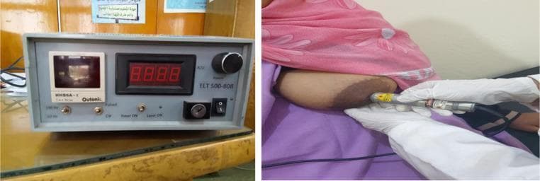 This composite clinical photograph illustrates the application of Photobiomodulation (PBM) therapy for lactation-related nipple pathology. The left panel shows a low-level diode laser device (808 nm) featuring a digital control panel with a four-digit LED display, a power adjustment knob labeled 'ELT 500-808', a safety key switch, and toggle switches for pulse and timer functions. The right panel displays the procedural application of the treatment. A healthcare professional wearing white clinical gloves uses a handheld laser probe to deliver targeted irradiation to the areola and nipple of a patient. The clinical focus is the management of inflammatory conditions, such as nipple fissures or mastitis, in breastfeeding individuals. The procedure aims to utilize low-level laser therapy (LLLT) to reduce pain (as measured by the Visual Analogue Scale), accelerate tissue repair, and decrease inflammation (erythema and heat) associated with breastfeeding trauma.