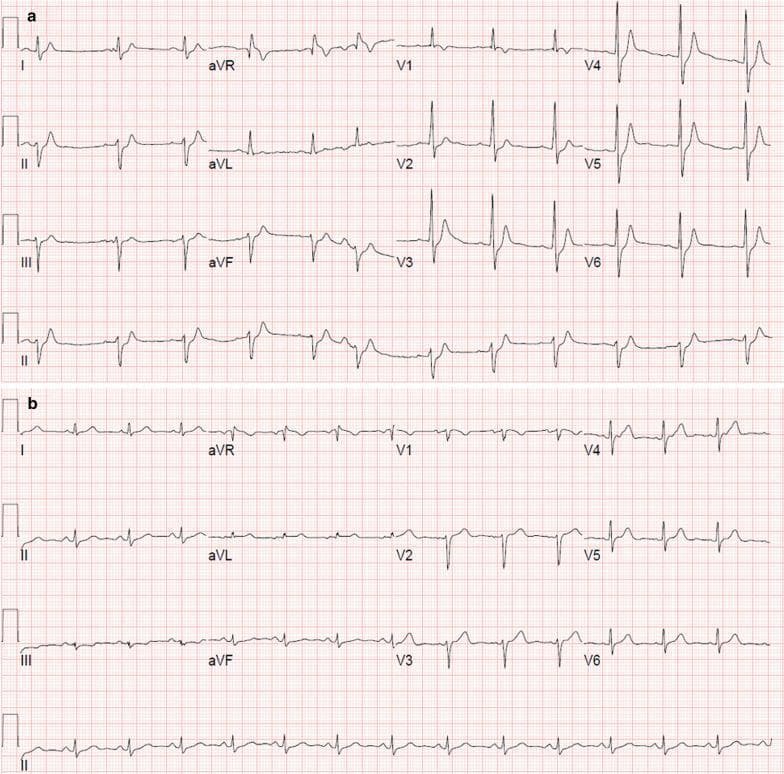 A side-by-side comparison of two 12-lead electrocardiograms (ECGs) demonstrating the visual characteristics of Short QT Syndrome (SQTS) versus a normal heart rhythm. Panel A shows a representative ECG from a patient with SQTS, characterized by a markedly shortened QT interval (306 ms) and corrected QT interval (QTc of 330 ms). Visually, this is evident by the short ST segment, with T waves beginning almost immediately after the narrow QRS complex. The T waves in Panel A, particularly in leads V2-V5, appear relatively tall, peaked, and symmetrical. Panel B shows a control ECG from a patient with a normal QTc of 432 ms and heart rate of 84/min. In contrast to Panel A, Panel B displays a distinct and longer ST segment between the end of the QRS complex and the onset of the T wave. The T waves in Panel B are broader and lower in amplitude compared to the peaked morphology seen in the SQTS patient. This clinical comparison illustrates the diagnostic criteria for SQTS, a rare channelopathy associated with sudden cardiac arrest.
