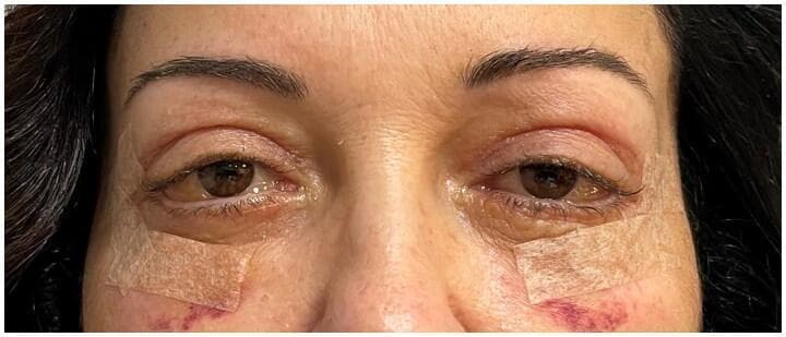 This clinical photograph shows a close-up frontal view of a patient's periorbital region, three weeks following bilateral blepharoplasty. The most prominent finding is severe bilateral conjunctival chemosis, characterized by translucent, bulbous swelling and elevation of the bulbar conjunctiva, making it appear thickened and puffy around the corneas. Visible erythema and vascular congestion are present in the ocular tissue. The periocular area shows typical postoperative changes, including moderate edema of the upper and lower eyelids and mild infraorbital ecchymosis (bruising) on the cheeks. Surgical adhesive tapes are applied to the lower eyelids/cheeks, and fine sutures are visible at the lateral canthi. The lower lids appear slightly retracted, likely due to the ongoing edema and surgical healing process. This image serves as an educational example of persistent postoperative chemosis, a known complication of eyelid surgery that requires clinical monitoring and potential medical or surgical intervention.