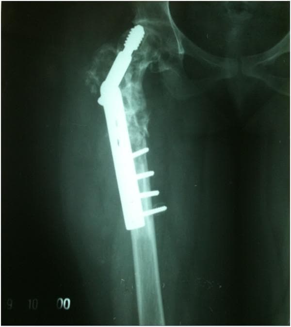 Anteroposterior (AP) X-ray of the right proximal femur and hip joint demonstrating hardware failure and significant bone pathology. A dynamic hip screw (DHS) implant is in situ, consisting of a side plate secured with four cortical screws to the femoral shaft and a large lag screw. The lag screw shows evidence of 'cut-out,' having migrated superiorly through the femoral head and penetrating into the joint space/acetabular region, indicating a failure of fracture stabilization. The proximal femur, including the neck, greater trochanter, and head, exhibits extensive, ill-defined radiolucent (lytic) lesions and a moth-eaten appearance, suggesting severe bone resorption or a pathological process such as hydatid disease. The normal trabecular pattern is lost, and the cortical thickness is irregularly reduced. This imaging illustrates implant failure secondary to poor bone quality and disease progression.