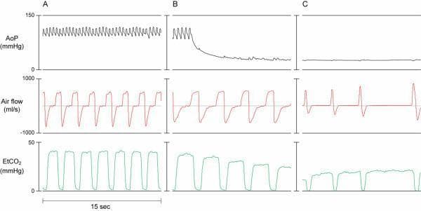 Comparison chart showing physiologic waveforms across three cardiovascular states: (A) Normal sinus rhythm with spontaneous breathing, (B) Acute ventricular fibrillation (VF) with initial spontaneous breathing, and (C) Untreated VF with agonal gasping. The chart tracks three parameters over 15-second intervals: Aortic Pressure (AoP in mmHg), Air Flow (ml/s), and End-tidal CO2 (EtCO2 in mmHg). In state A, AoP shows regular rhythmic oscillations, and air flow exhibits a plateau in the inspiratory phase. In state B, AoP demonstrates a rapid decay in pulse pressure and mean arterial pressure following VF induction; air flow remains relatively regular but with slightly reduced amplitude and EtCO2 begins to decline. In state C, AoP is nearly flat, indicating a lack of cardiac output; the air flow signal transforms into sharp, infrequent 'gasping' peaks characterized by a lack of an inspiratory plateau and a rapid rise and fall, while the EtCO2 signal becomes irregular and significantly lower in amplitude. This infographic illustrates the hemodynamic and ventilatory changes during the progression of cardiac arrest.