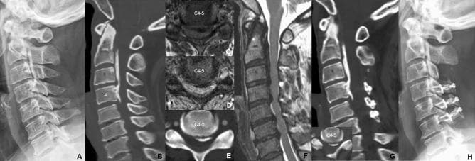 This composite figure presents a longitudinal clinical case of cervical myelopathy due to Ossification of the Posterior Longitudinal Ligament (OPLL). Panels A-F show preoperative status: Lateral X-ray (A) and sagittal CT (B) reveal extensive OPLL. Axial MRI (C, D) and CT (E) at the C4-C5 level demonstrate severe spinal canal stenosis and cord compression caused by a large, centrally-to-left located ossified mass. Sagittal T2-weighted MRI (F) confirms multilevel cord compression and high intramedullary signal intensity. Panels G and H show postoperative results: Sagittal CT (G) and lateral X-ray (H) at 4-year follow-up demonstrate surgical decompression via C4-C6 open-door laminoplasty and C3 laminectomy with C2 dome-like laminoplasty. Surgical hardware including titanium mini-plates and mini-screws are clearly visible, maintaining the expanded spinal canal while preserving cervical lordosis and sagittal alignment. The image illustrates the radiological diagnosis of OPLL and the structural outcomes of posterior decompressive surgery using laminoplasty spacers.