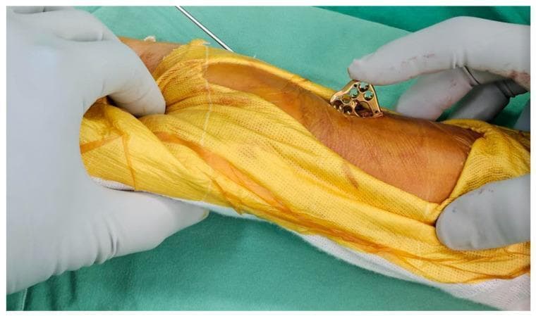 This clinical photograph captures a key step in an orthopedic surgical procedure for distal radius fracture fixation using a mini-incision technique. A surgeon's gloved hand is shown inserting a gold-colored, metallic 2.4 mm variable-angle locking compression plate (LCP) through a small volar incision in the wrist area. The plate features a contoured multi-holed head designed for anatomical fit and is oriented perpendicularly to the skin surface to allow one distal corner to enter the wound first, minimizing soft tissue trauma. The surgical field is prepared with yellow antimicrobial drapes and green surgical cloths, with a thin K-wire partially visible, indicating prior temporary fracture stabilization. This image demonstrates the 'ultimate mini-incision' approach, emphasizing the precise handling and positioning of internal fixation hardware in a restricted surgical window to optimize clinical outcomes and minimize scarring in wrist fracture management.