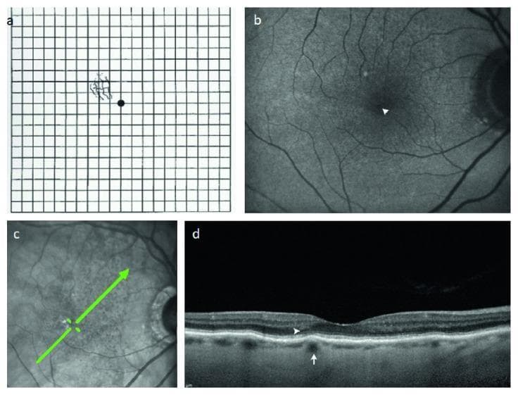 This four-panel image series illustrates the clinical and diagnostic findings of focal choroidal elevation (FCE) in a patient with atrophic age-related macular degeneration (ARMD). Panel (a) shows an Amsler grid with patient-drawn wavy, irregular lines (metamorphopsia) in the superior-nasal quadrant relative to the central fixation point. Panel (b) presents fundus autofluorescence (FAF) of the right eye, highlighting a pinpoint area of relative hypoautofluorescence (white arrowhead). Panel (c) is a scanning laser ophthalmoscopic (SLO) image with a green arrow indicating the scan location for the subsequent Spectral Domain Optical Coherence Tomography (SD-OCT). Panel (d) displays the SD-OCT cross-section, revealing a focal choroidal elevation (white arrow) characterized by a localized upward protrusion of the choroid. Overlying this elevation, a white arrowhead identifies a subtle disruption of the ellipsoid zone (IS/OS line), which corresponds to the area of metamorphopsia reported on the Amsler grid. The sequence demonstrates the anatomical correlation between deep choroidal structural changes and functional visual distortion in ARMD.