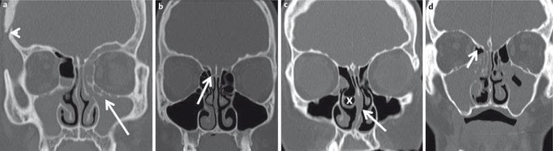 This diagnostic image set consists of four coronal low-dose CT (ldCT) scans of the paranasal sinuses, illustrating various anatomical variants and pathological findings relevant to Functional Endoscopic Sinus Surgery (FESS). Panel (a) shows bilateral complete maxillary sinus opacification and a left-sided infraorbital ethmoid cell (Haller cell) obstructing the ostiomeatal complex, with evidence of prior cranial surgery (arrowhead). Panel (b) highlights an ethmoid bulla and a Keros type II cribriform plate variant, indicating a moderate depth of the olfactory fossa. Panel (c) demonstrates a right-sided concha bullosa (pneumatized middle turbinate, marked 'x'), a deviated nasal septum to the left with a bony spur, and an opacified ethmoid bulla. Panel (d) illustrates a Keros type I cribriform plate (shallow olfactory fossa) and a small bony spur near the anterior ethmoid artery. These images serve as an educational comparison of sinonasal anatomy, highlighting variants like the Haller cell and concha bullosa that contribute to chronic rhinosinusitis and surgical risk.