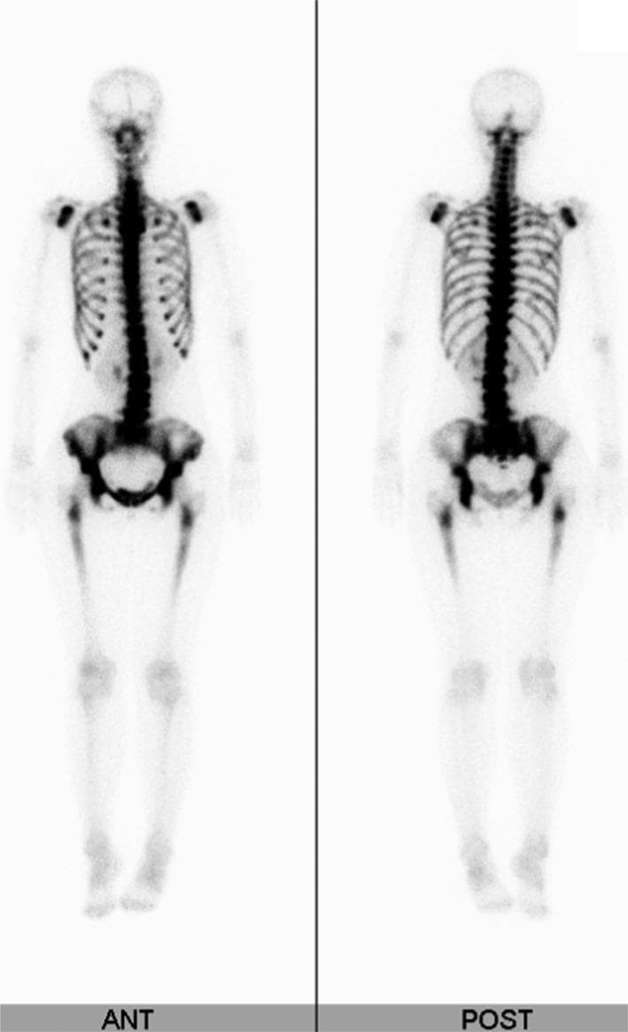 This diagnostic image shows anterior (ANT) and posterior (POST) whole-body views of a nuclear medicine bone scintigraphy (bone scan) using technetium-99m methylene diphosphonate (Tc-99m MDP). The scan demonstrates a classic 'superscan' pattern, often referred to as the 'beautiful bone sign' in specific clinical contexts. Visually, there is intense, diffuse, and symmetrical radiotracer uptake throughout the axial skeleton, including the entire vertebral column, ribs, and sternum. The pelvic girdle, particularly the iliac alae and sacrum, shows markedly increased activity. A key diagnostic feature is the complete absence of radiotracer visualization in the kidneys and urinary bladder ('absent kidney sign'), occurring because the skeletal system is sequestering the majority of the tracer due to high metabolic turnover. The appendicular skeleton shows uptake primarily in the proximal humeri and femora, with significantly reduced visualization of the distal extremities and soft tissues. This pattern is highly suggestive of diffuse osteoblastic metastatic disease, commonly associated with disseminated carcinomatosis of the bone marrow from primary malignancies like gastric or breast adenocarcinoma.