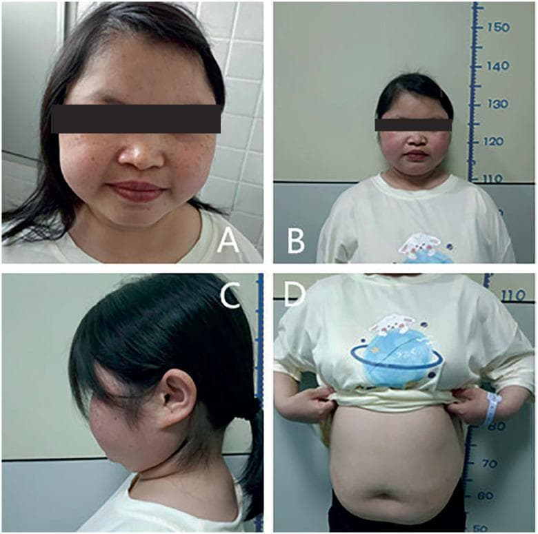 A multi-panel clinical photograph illustrating the classic physical manifestations of hypercortisolism (Cushing's syndrome). Image A provides a close-up of the face, demonstrating a 'moon face' appearance characterized by facial rounding and fullness of the cheeks, accompanied by multiple facial lentigines and mild acne. Image B shows the patient standing against a height scale, highlighting short stature relative to chronological age. Image C is a lateral view of the neck and upper back, showing a dorsocervical fat pad (buffalo hump). Image D displays the torso, revealing centripetal obesity with a protuberant, rounded abdomen; notably, this specific case lacks the characteristic wide, violaceous striae often seen in Cushing's syndrome, though the skin appears thin. This composite clinical image serves as an educational tool for identifying the systemic and dermatologic signs of primary pigmented nodular adrenocortical disease (PPNAD) or other causes of chronic glucocorticoid excess in pediatric or adolescent patients.