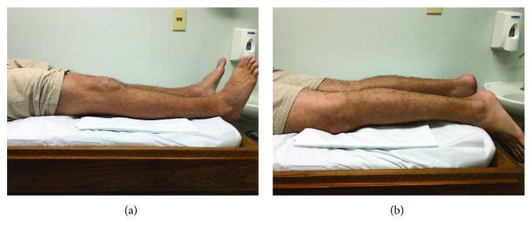 Two-panel clinical photograph demonstrating the objective measurement of knee extension deficit in a 25-year-old male. The patient is positioned prone on an examination table. Panel (a) shows the initial state following a medial meniscus bucket handle tear, where an extension lag is visible: the right knee remains flexed, causing the lower leg and foot to be elevated and dorsiflexed off the table surface compared to the contralateral side. Panel (b) illustrates the clinical outcome after a rehabilitative exercise protocol targeting arthrogenic muscle inhibition and hamstring contracture. In this image, the patient achieves full passive and active extension, with the entire length of the lower limb, including the knee, shin, and top of the foot, resting flat and parallel to the examination table surface. These images are used in orthopedics and physical therapy to document the progression of joint range of motion and the efficacy of manual or exercise-based interventions for locked knee symptoms.
