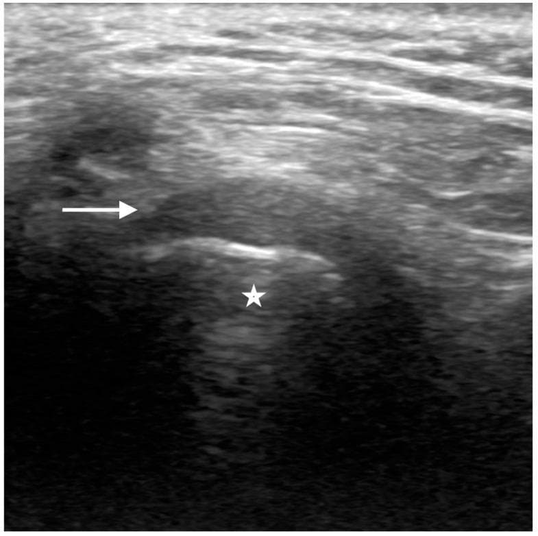 This longitudinal diagnostic ultrasound image illustrates the normal anatomy of the human temporomandibular joint (TMJ) in a closed-mouth position. The mandibular condyle is identified as a central hypoechoic region (marked with a star), bounded superiorly by a distinct, bright hyperechoic line representing the condylar cortex. Situated immediately superior to the condylar cortex is the articular disc (indicated by a white arrow), which presents as a hypoechoic, inverted C-shaped structure. This imaging modality and view are essential for evaluating the relationship between the disc and the condyle to rule out internal derangement, such as disc displacement. The image highlights the characteristic echogenicity of normal TMJ components: the hyperechoic bone cortex and the hypoechoic fibrocartilaginous disc. This content is relevant for radiology and dentistry education, specifically for teaching musculoskeletal ultrasound techniques and diagnostic criteria for normal joint function.