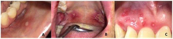 This composite clinical photograph illustrates the three primary classifications of Recurrent Aphthous Stomatitis (RAS) within the oral cavity. (A) Minor RAS: A single, small, well-defined oval ulcer on the buccal mucosa characterized by a central yellowish-white fibrinous pseudomembrane and a prominent peripheral erythematous halo. (B) Major RAS: Large, irregular, and deep ulcerations located on the soft palate and oropharynx. These lesions exceed 1 cm in diameter, exhibiting extensive tissue destruction, yellowish necrotic centers, and significant surrounding inflammation. (C) Herpetiform RAS: Multiple, pinpoint-sized (1-3 mm) ulcers clustered in a dense distribution along the gingival and labial mucosa. These lesions present as numerous discrete, intensely erythematous points that can coalesce into larger irregular areas. This comparative series serves as a diagnostic educational tool for distinguishing between aphthous variants based on ulcer size, morphology, quantity, and anatomical distribution in dental and dermatological clinical practice.